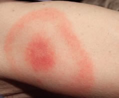 Ticks & Lyme Disease
